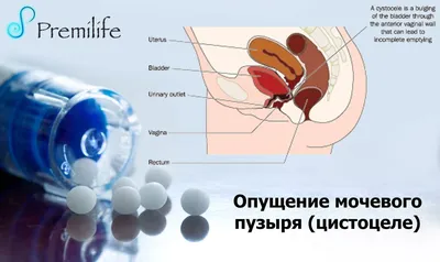 Инвагинация, выпадение слизистой уретры у женщин. | Уролог в Омске на  Березовой.