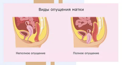 Что делать при недержании мочи: решение нестыдной проблемы