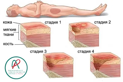 Пролежни фото картинки фотографии