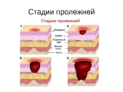 Пролежни. Сквозная боль - КОМАНДА \"МЕТЕЛИЦА\"