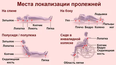 Модель стопы с пролежнями человека преклонного возраста