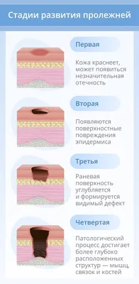 Чем опасна температура при пролежнях? | Добрый мир