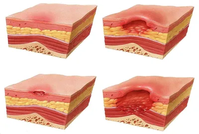 Что такое пролежни | Дом престарелых Гармония