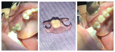 Осложнения после съемного протезирования зубов в стоматологии