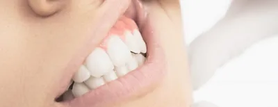 Несъемные зубные протезы в Омске по доступным ценам и гарантией по  стандарту Минздрава РФ