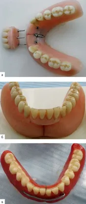 Проблемы, возникающие при протезировании зубов