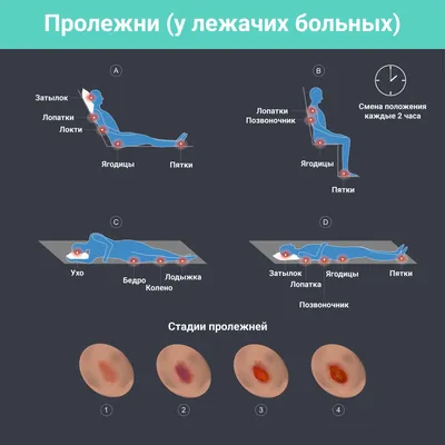 Пролежни - лечение дома и профилактика, обработка в домашних условиях