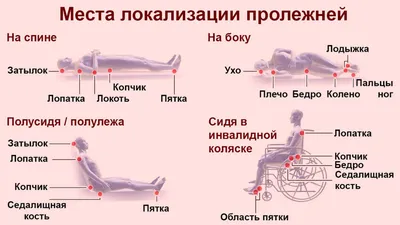 Профилактика пролежней у лежачих больных - АНО СОН \"Радуга Добра\"