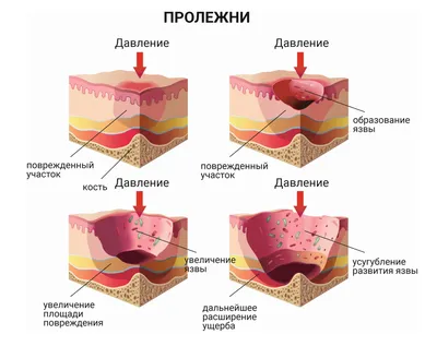 Пролежни - лечение дома и профилактика, обработка в домашних условиях