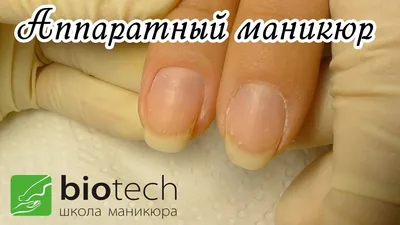 Избавление от онихорексиса (продольное расслоение) ногтевой пластины в  Центре подологии СТОПАМЕР