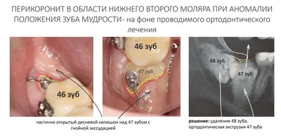 Синяя десна при прорезывании зубов у детей