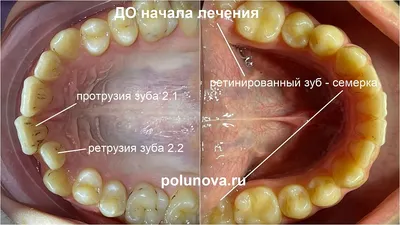 Глазные Зубы У Детей 9 Фото Клыки У Ребенка ЛюмиДент