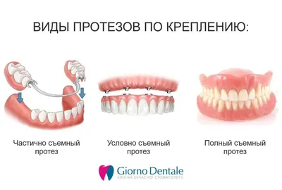 🦷 Протезирование зубов ☑ Стоматология в Киеве и Львове ☑ Giorno Dentale