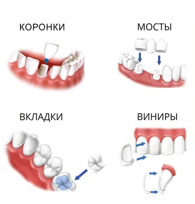 Протезирование зубов | Клиника «Индент»