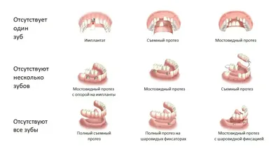 Протезирование зубов в Калуге по выгодным ценам ? | Здоровые Зубки