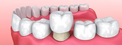 Протезирование зубов в Калининграде | зубной протез | Калининград |  недорого | цена | отзывы