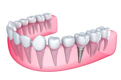 Протезирование зубов в СПб недорого, цены на зубные протезы нового  поколения, стоимость установки, качественное лечение и протезирование в  кредит и рассрочку в клинике «СТОМА»