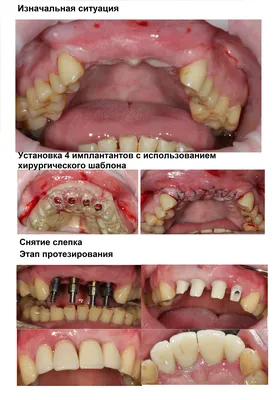 Протезирование на имплантах - Стоматологическая клиника в москве -  «Интерстом»