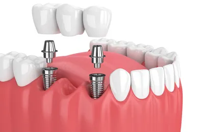 🦷 Качественное протезирование зубов во Владимире: отзывы, цены и виды