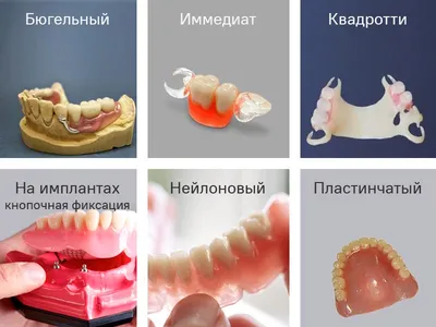 Протезирование зубов в Ульяновске все цены, съемное протезирование верхней  и нижней челюсти.