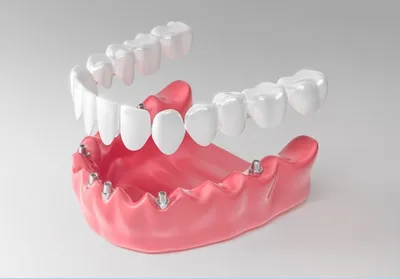 Протезирование зубов на 4 имплантах | Эликсир-Дента