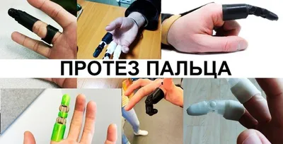 ПРОТЕЗ ПАЛЬЦА. Функциональный протез на 3 пальца. Обморожение  (указательный, средний, безымянный) - YouTube