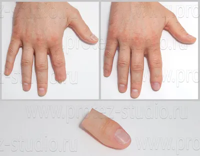 Протезы пальцев рук фото фотографии