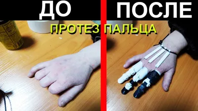 Протезирование пальцев рук, ног - цена в Москве|косметический протез  фаланги пальца руки, ноги