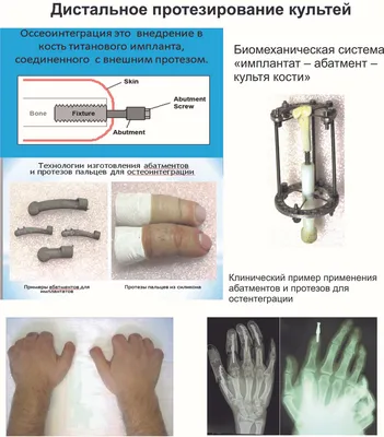 Протезы пальцев - Орто-Космос