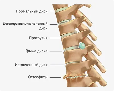 Грыжа шейного отдела позвоночника
