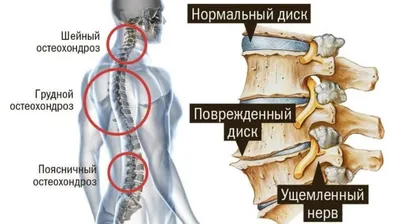 Грыжи шейного и грудного отдела позвоночника. - Первая Медицинская Клиника