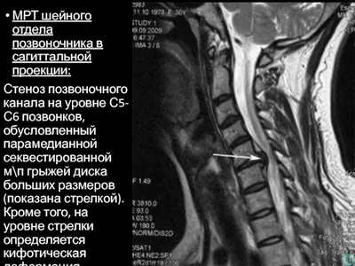 Дегенеративные изменения межпозвоночных дисков шейного отдела позвоночника  | Второе мнение