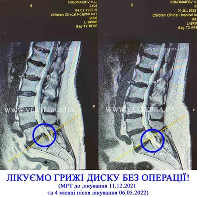 Протрузия шейного отдела позвоночника - диагностика и лечение