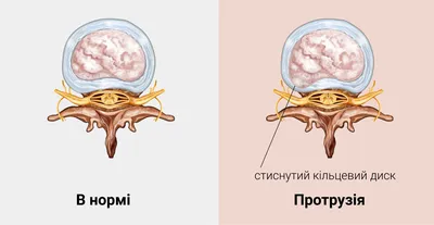 Грыжа С5–С6 шейного межпозвонкового диска, лечение, операция, симптомы