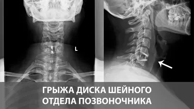 Протрузия грудного отдела - Доктор Позвонков