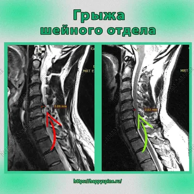 Лечение грыжи грудного отдела позвоночника: лучшие безоперационные  методики. Клиника Бобыря
