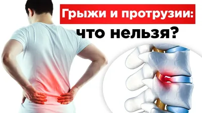 Остеохондроз: шейный, грудной, поясничный, симптомы, лечение