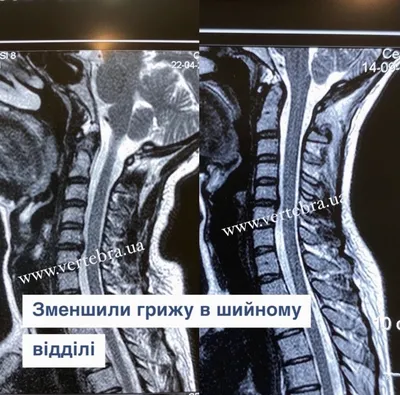 Протрузия дисков шейного отдела лечение в «Здоровье нации» центр  кинезитерапии в Днепре