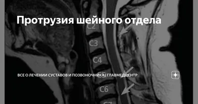Грыжа диска шейного отдела позвоночника - симптомы и лечение - YouTube