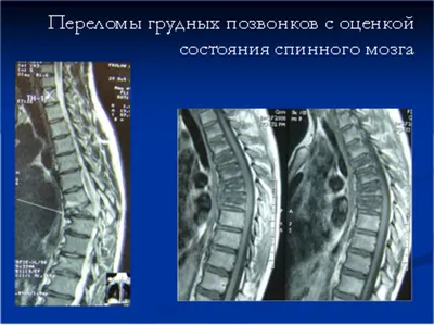 Протрузия шейного отдела позвоночника: симптомы, лечение и особенности  дисков с4 с5 и с5 с6