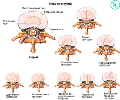 Протрузия межпозвонкового диска - лечение в Киеве - Vertebra