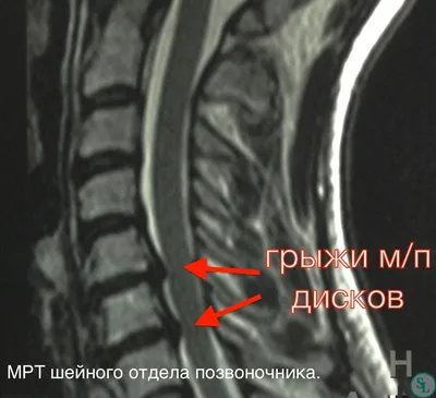 Грыжа межпозвоночного диска: причины, симптомы и лечение