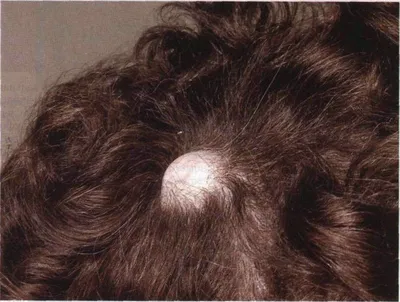 Прыщи на голове в волосах: причины и лечение | Блог IHC Clinic