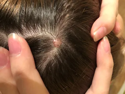 Как лечить болячки в волосах на коже головы | Блог IHC Clinic
