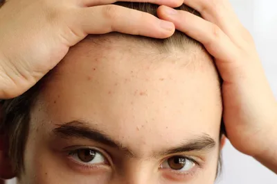 Прыщи на голове в волосах: причины и лечение | Блог IHC Clinic