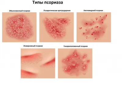 Псориаз: что это, причины, симптомы, стадии, эффективное лечение болезни