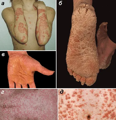 Псориаз: как избежать рецидива - Столин ЦГЭ