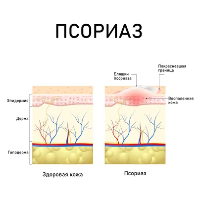 Поликлиника №10 - 29 октября 2021 года - республиканский день профилактики  псориаза - Новости и объявления