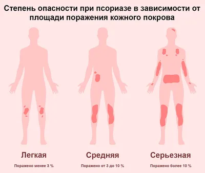 Лечение псориаз кожи в медцентре \"Т-Медикус\" Алматы | Медицинский центр  \"Т-Медикус\"