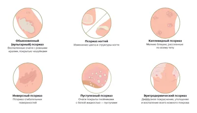 Псориаз волосистой части головы. Симптомы | МЦ Данимед